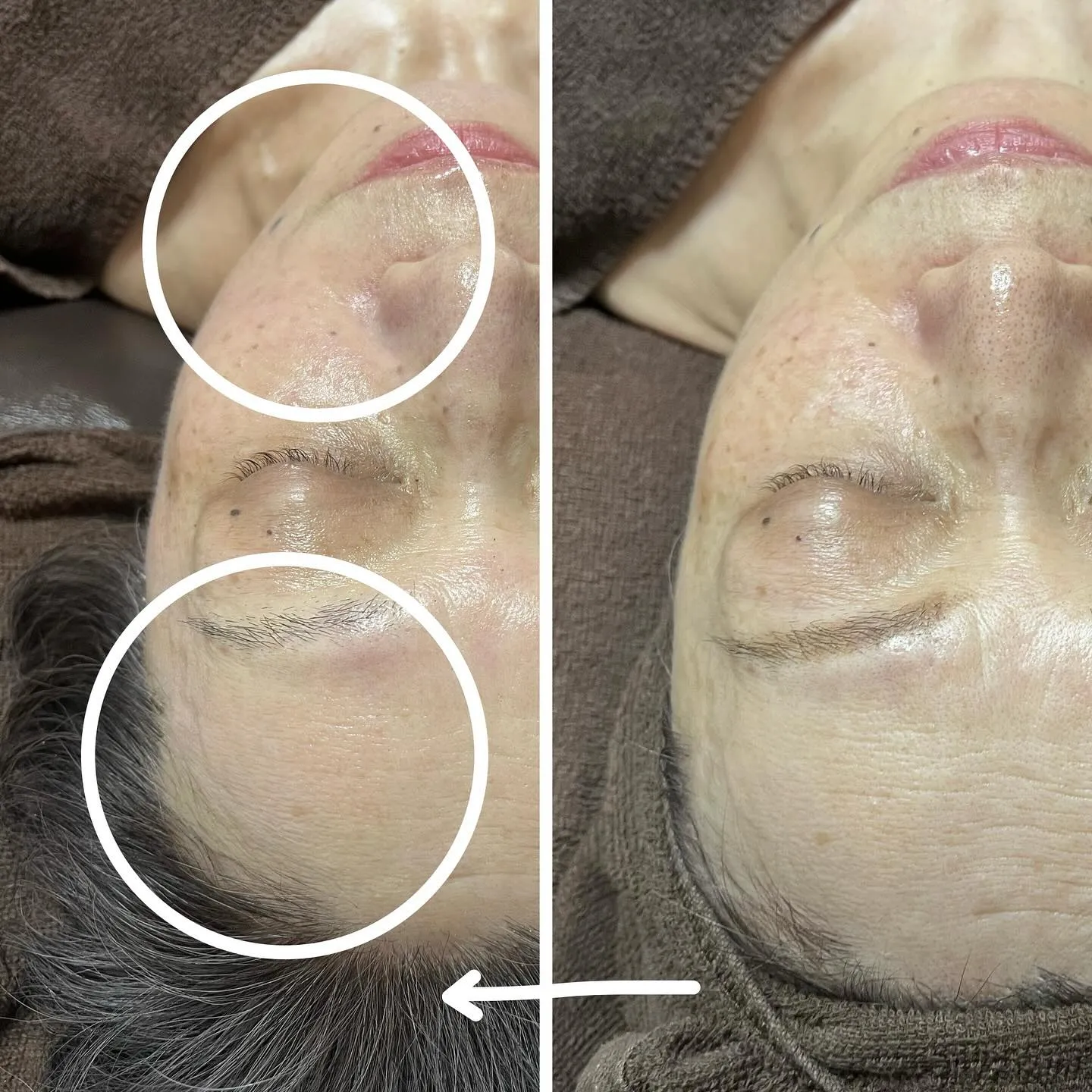 正しいハーブピーリング とは